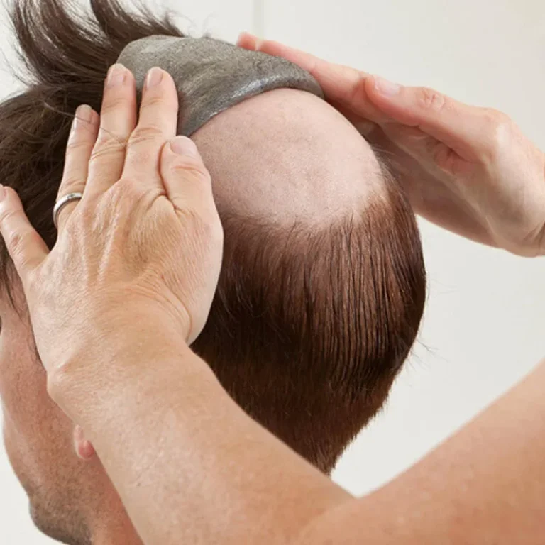 non-srgical-hair-fixing_1